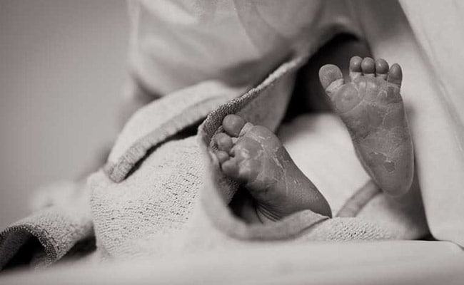 2 Fetuses Successfully Removed From Newborn's Abdomen In Maharashtra