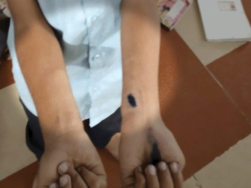 गुजरात में ₹10 के लिए 40 बच्चों ने हाथ काटे:‘डेयर गेम' खेल रहे थे पांचवीं-सातवीं के स्टूडेंट्स; जिसके ज्यादा घाव, उसे इनाम