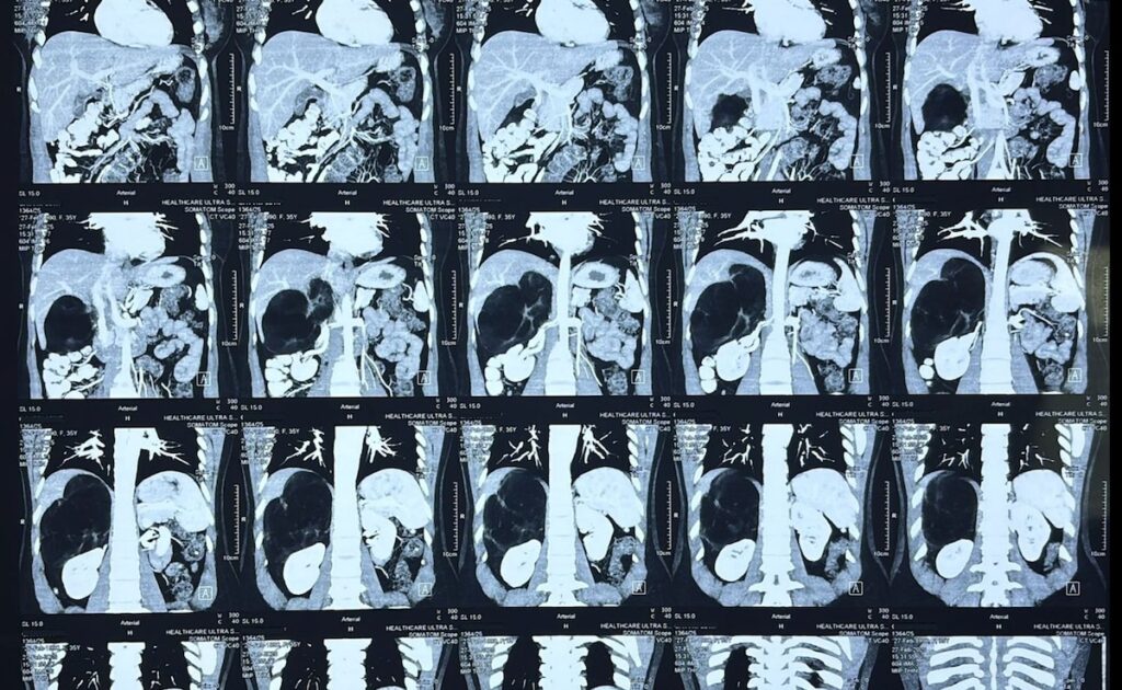 World's Largest Adrenal Tumor Removed Robotically At Delhi Hospital