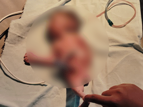 छत्तीसगढ़ में 'मरमेड बेबी' का जन्म, 3 घंटे में मौत:नवजात के दोनों पैर जलपरी जैसे जुड़े हुए थे, डॉक्टर बोले-दुनिया में सिर्फ 300 केस