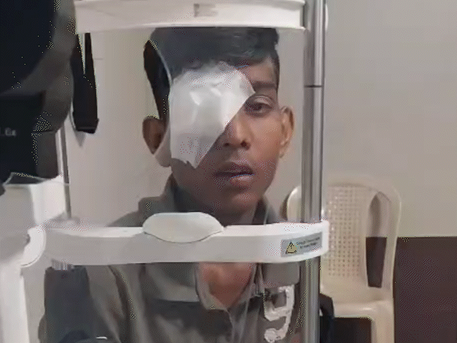 बंदर भगाने वाला देसी जुगाड़ पटाखा नहीं, बल्कि एक्सप्लोसिव डिवाइस:ICMR ने 2023 में चेतावनी दी थी; अब तक MP में 300 लोगों की आंखें झुलसीं